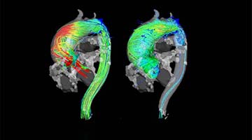 4D flow MRI visualizes 3D blood flow characteristics in a patient with ascending aortic aneurysm